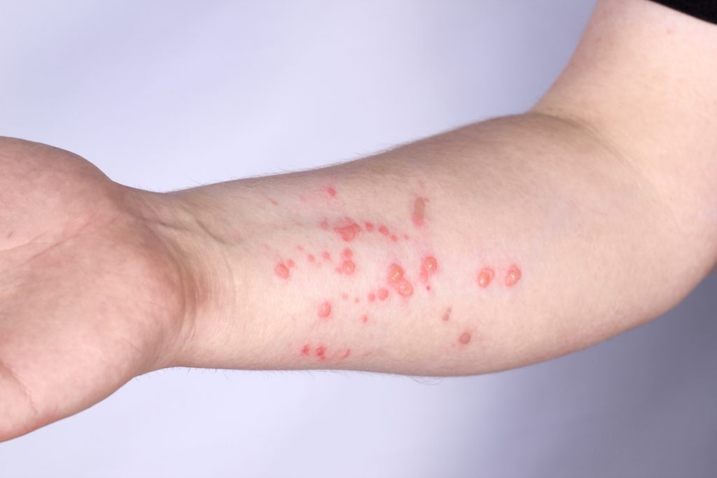 Mecklenburg County Expands Monkeypox Vaccine Eligibility